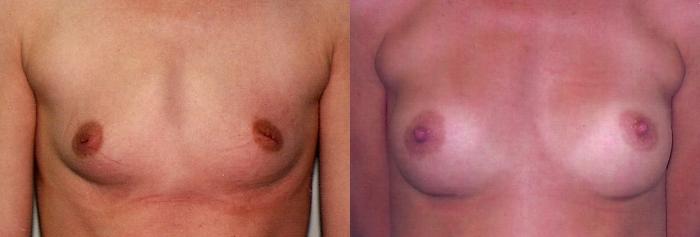 Before & After Breast Augmentation Case 27 View #2 View in Mississauga & Toronto, ON
