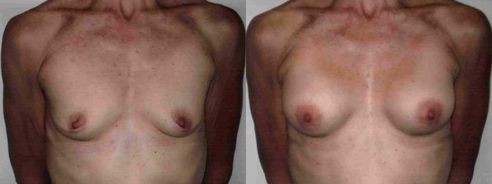 Before & After Breast Augmentation Case 4 View #2 View in Mississauga & Toronto, ON