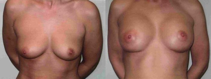 Before & After Breast Augmentation Case 8 View #1 View in Mississauga & Toronto, ON