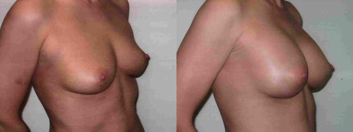 Before & After Breast Augmentation Case 8 View #2 View in Mississauga & Toronto, ON