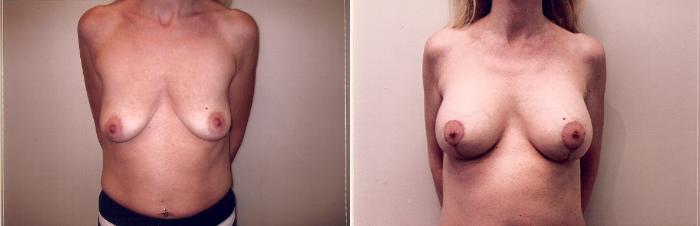 Before & After Breast Lift Case 36 View #1 View in Mississauga & Toronto, ON