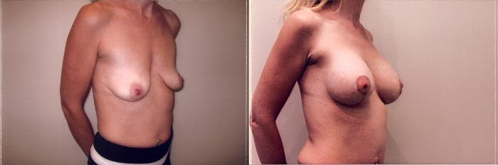 Before & After Breast Lift Case 36 View #2 View in Mississauga & Toronto, ON