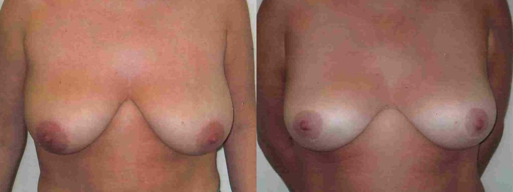 Before & After Breast Reduction Case 14 View #1 View in Mississauga & Toronto, ON