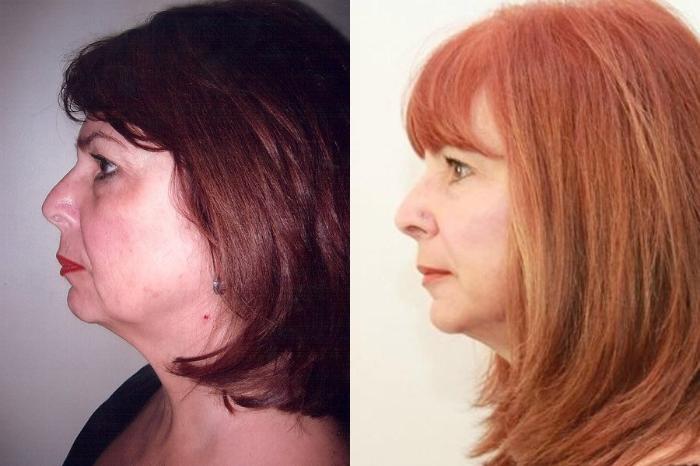 Before & After Facelift & Neck Lift Case 2 View #3 View in Mississauga & Toronto, ON