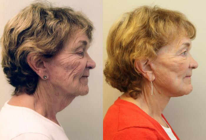 Before & After Facelift & Neck Lift Case 59 View #2 View in Mississauga & Toronto, ON