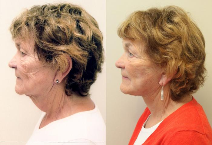 Before & After Facelift & Neck Lift Case 59 View #3 View in Mississauga & Toronto, ON