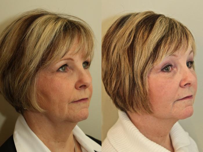 Before & After Brow Lift Case 77 View #1 View in Mississauga & Toronto, ON