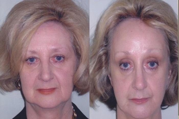 Before & After Brow Lift Case 83 View #1 View in Mississauga & Toronto, ON