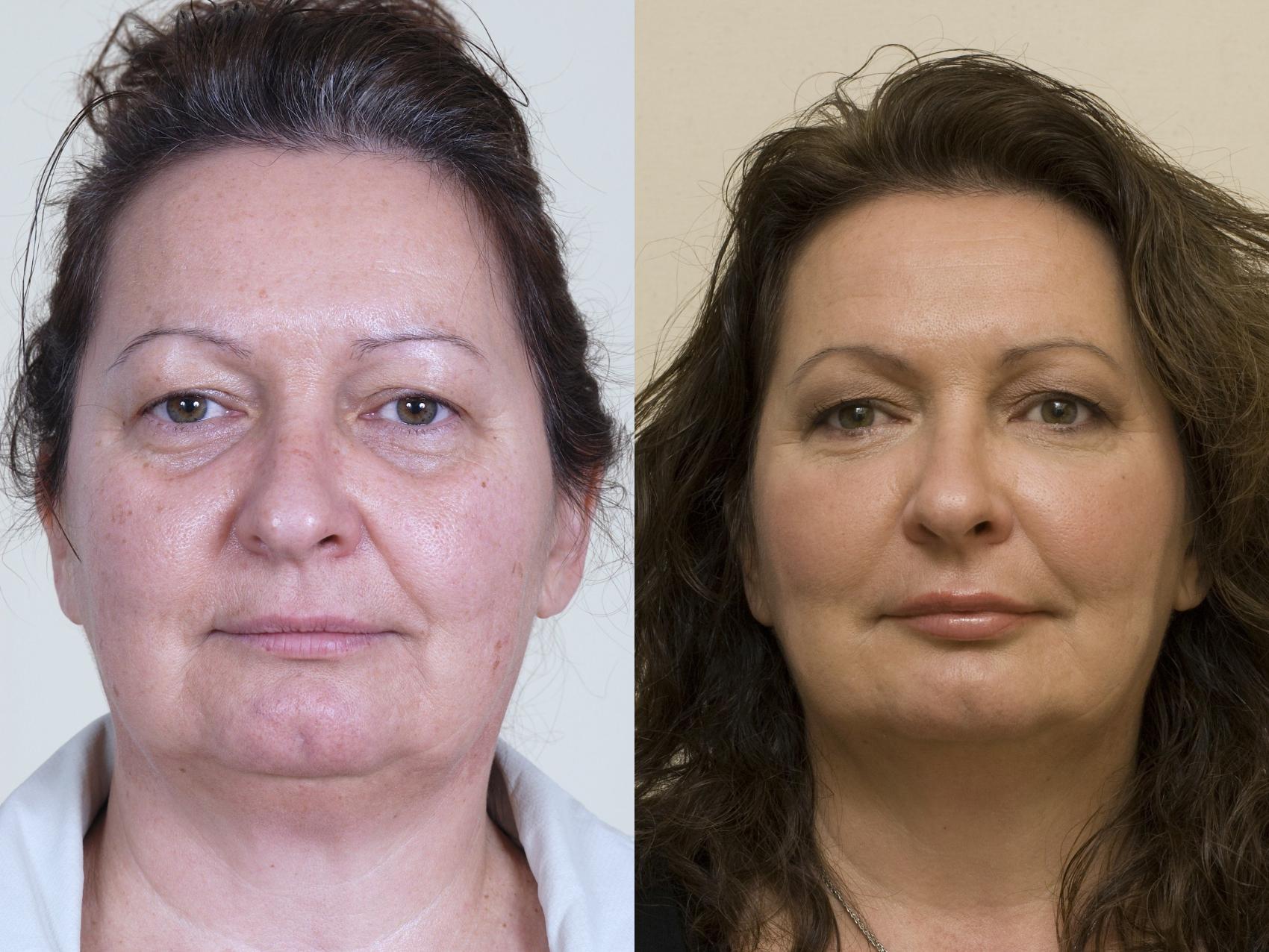 Before & After Injectable Fillers Case 40 View #1 View in Mississauga & Toronto, ON