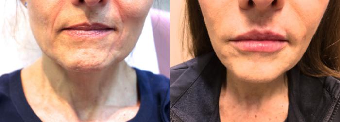 Before & After Injectable Fillers Case 103 View #1 View in Mississauga & Toronto, ON