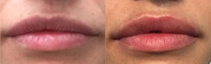 Before & After Injectable Fillers Case 104 Front View in Mississauga & Toronto, ON