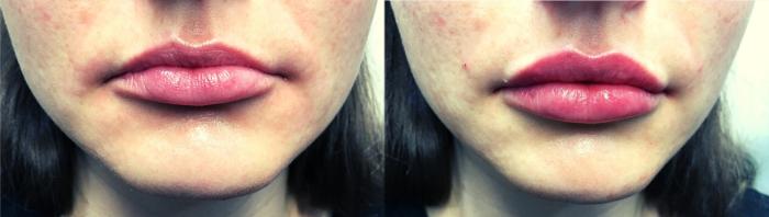 Before & After Injectable Fillers Case 108 Front View in Mississauga & Toronto, ON