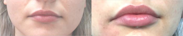 Before & After Injectable Fillers Case 125 Front View in Mississauga & Toronto, ON