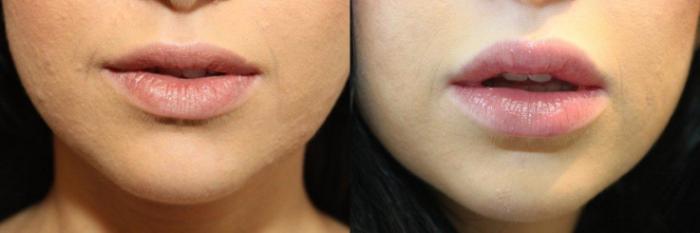 Before & After Injectable Fillers Case 74 View #1 View in Mississauga & Toronto, ON