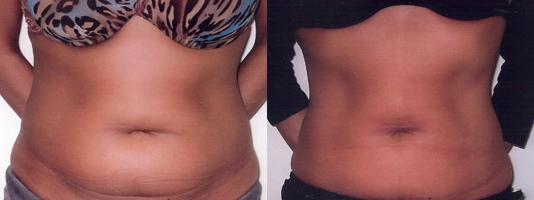 Before & After Liposuction Case 16 View #1 View in Mississauga & Toronto, ON