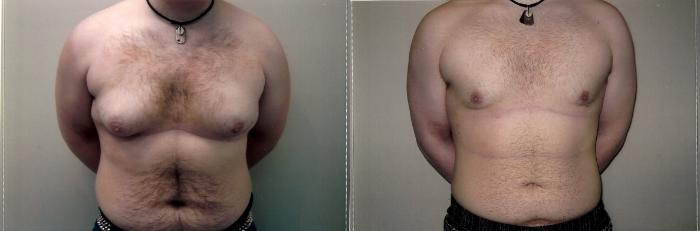 Before & After Male Breast Reduction Case 68 View #1 View in Mississauga & Toronto, ON