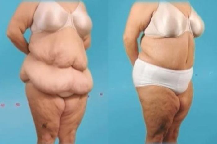 Before & After Massive Weight Loss Case 33 View #2 View in Mississauga & Toronto, ON