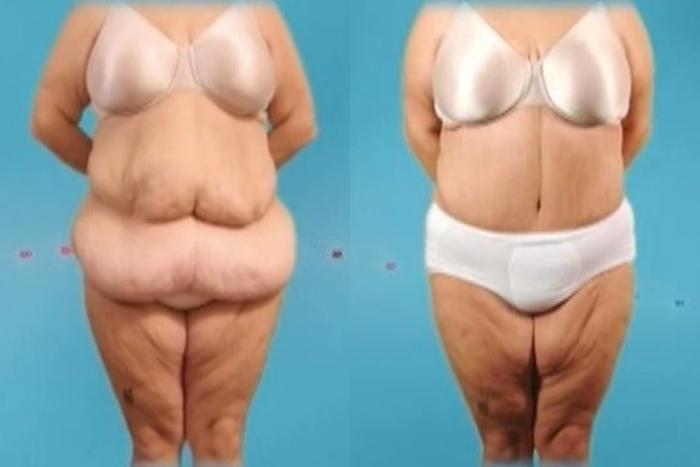 Before & After Massive Weight Loss Case 33 View #3 View in Mississauga & Toronto, ON