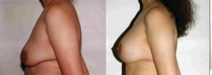 Before & After Breast Lift Case 45 View #1 View in Mississauga & Toronto, ON