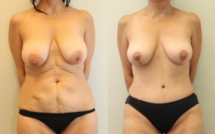Before & After Breast Lift Case 80 View #1 View in Mississauga & Toronto, ON