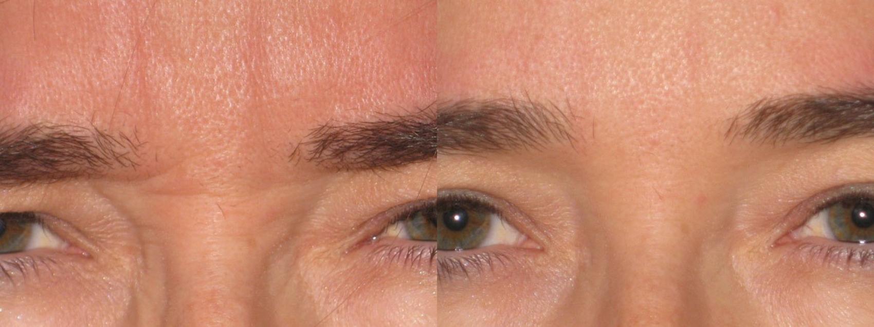 Before & After Prescription Wrinkle Injections Case 12 View #1 View in Mississauga & Toronto, ON