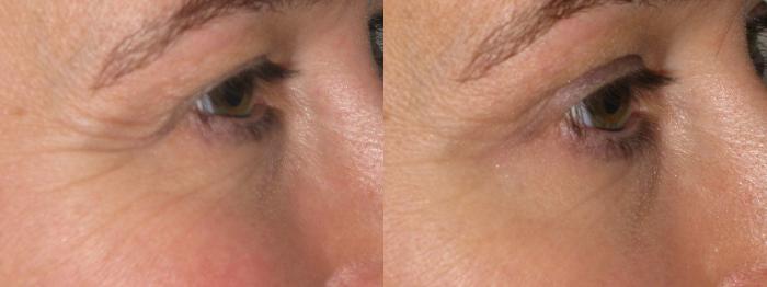 Before & After Prescription Wrinkle Injections Case 12 View #2 View in Mississauga & Toronto, ON