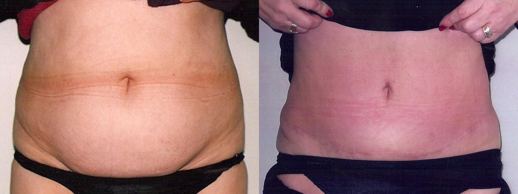 Before & After Tummy Tuck Case 13 View #1 View in Mississauga & Toronto, ON