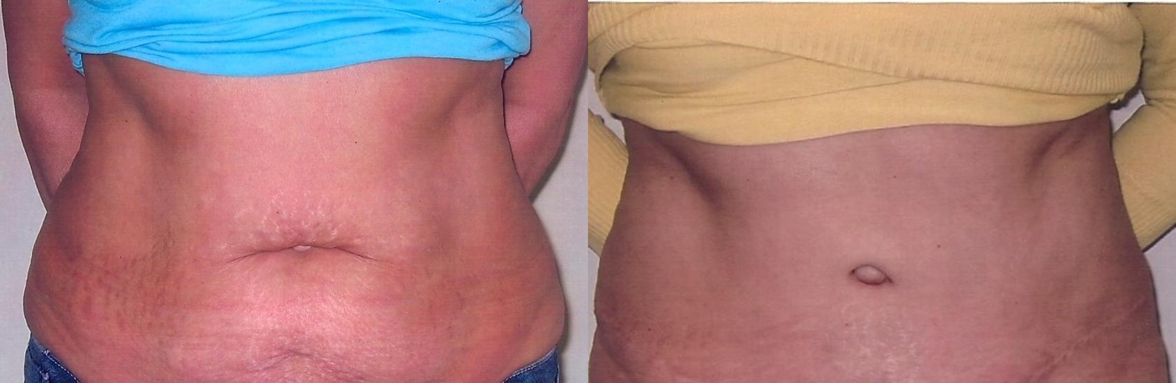 Before & After Tummy Tuck Case 47 View #1 View in Mississauga & Toronto, ON