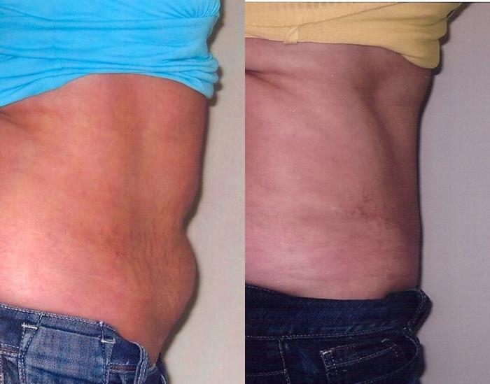 Before & After Tummy Tuck Case 47 View #2 View in Mississauga & Toronto, ON