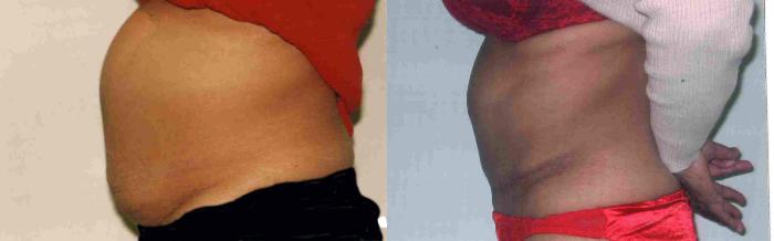 Before & After Tummy Tuck Case 65 View #2 View in Mississauga & Toronto, ON