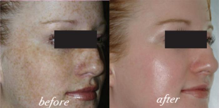 Before & After Alumier MD Glow Peel Case 114 Front View in Mississauga & Toronto, ON