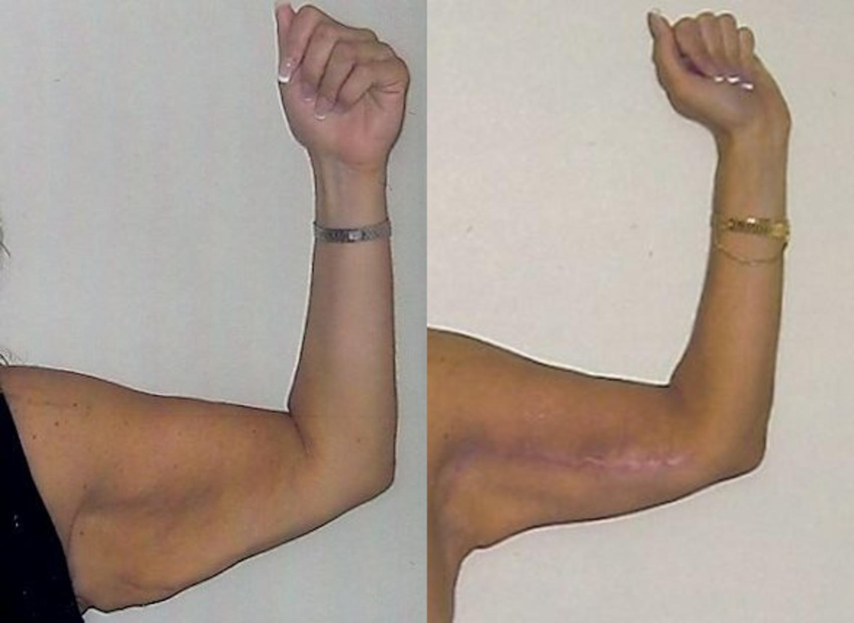 Before & After Arm Lift (Brachioplasty) Case 67 View #2 View in Mississauga & Toronto, ON