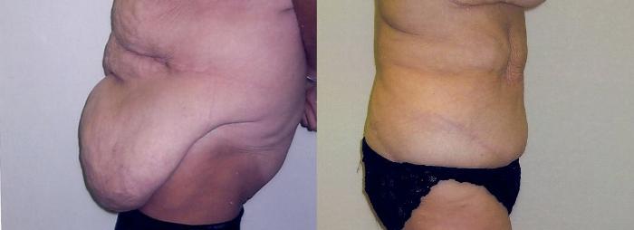 Before & After Massive Weight Loss Case 67 View #3 View in Mississauga & Toronto, ON