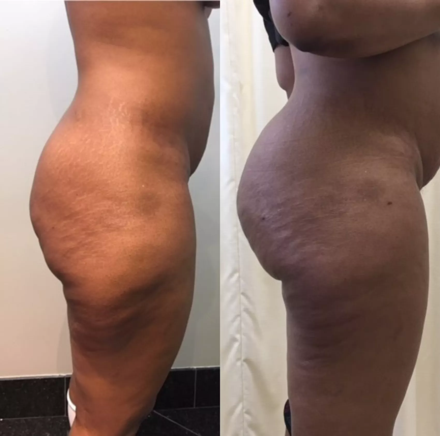 Brazilian Butt Lift Toronto - Visage Cosmetic Plastic Surgery