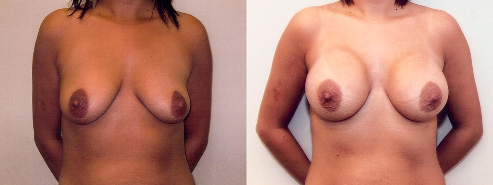 Before & After Breast Augmentation Case 1 View #1 View in Mississauga & Toronto, ON