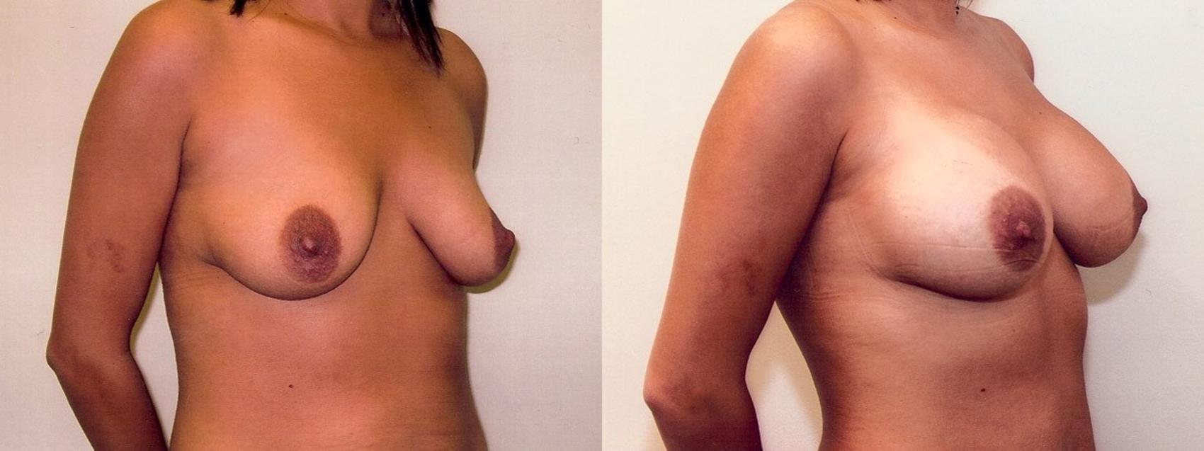 Before & After Breast Augmentation Case 1 View #2 View in Mississauga & Toronto, ON