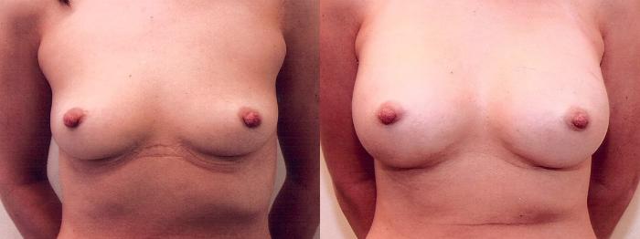 Before & After Breast Augmentation Case 11 View #1 View in Mississauga & Toronto, ON