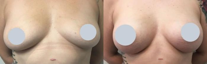 Before & After Breast Augmentation Case 110 Front View in Mississauga & Toronto, ON