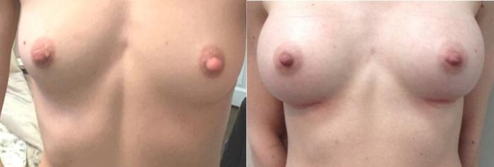 Before & After Breast Augmentation Case 122 Front View in Mississauga & Toronto, ON
