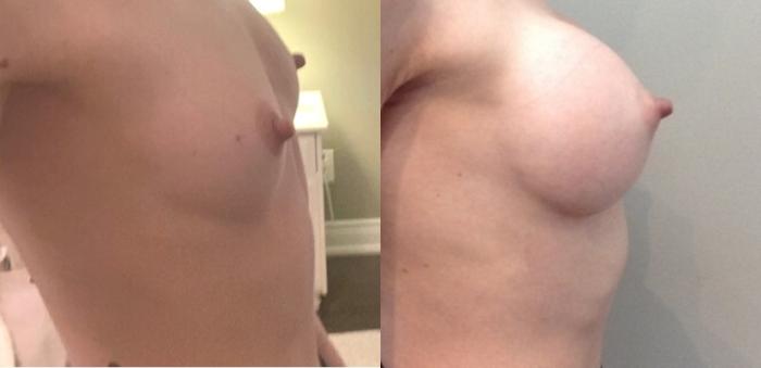 Before & After Breast Augmentation Case 122 Right Side View in Mississauga & Toronto, ON
