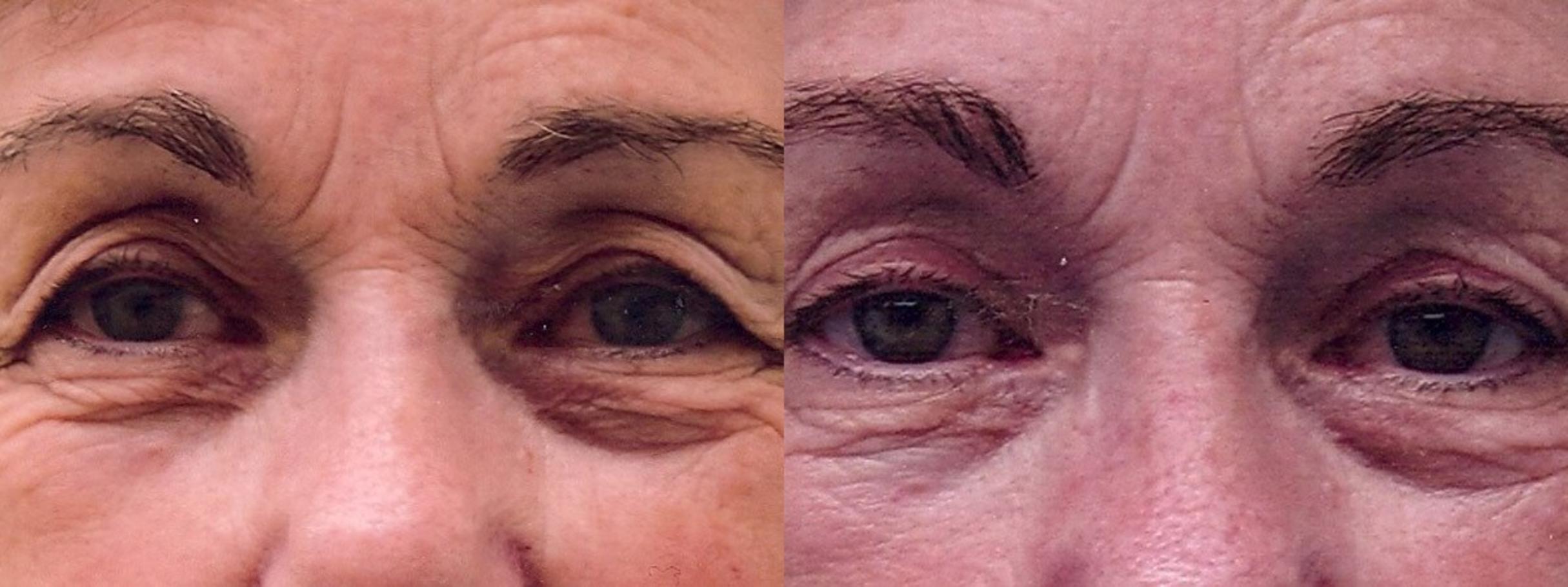 Before & After Eyelid Surgery Case 15 View #1 View in Mississauga & Toronto, ON