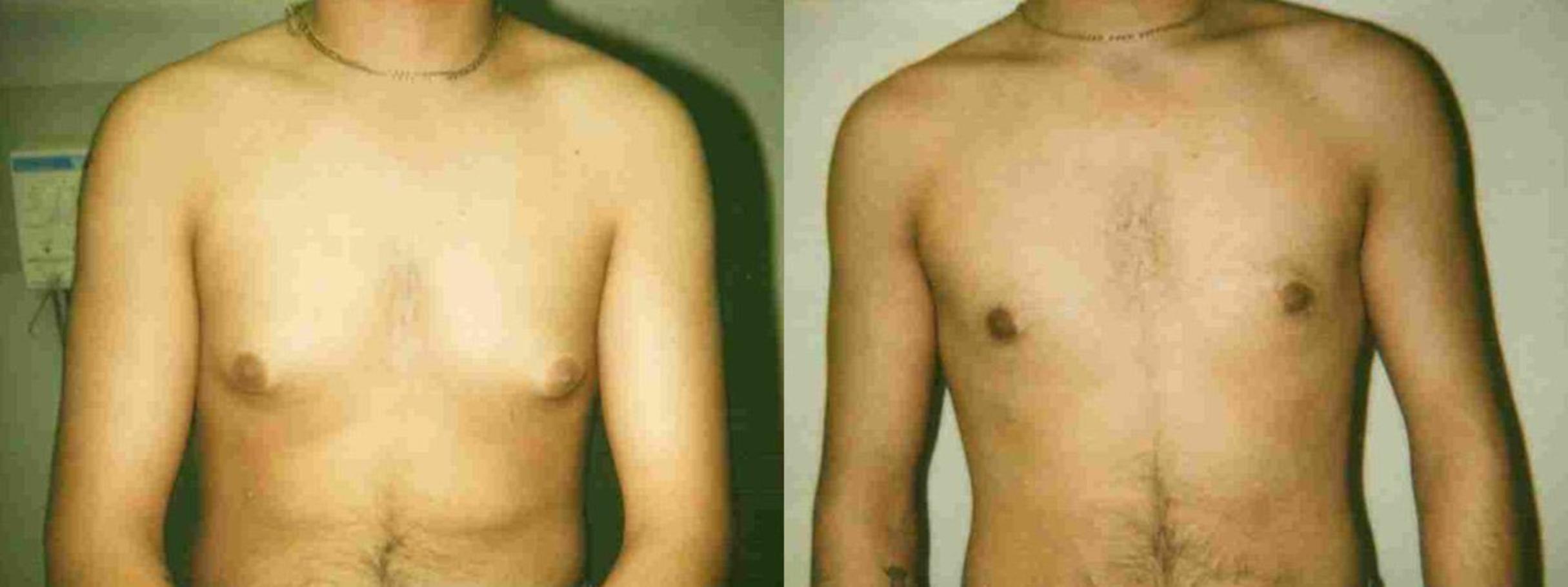 Before & After Male Breast Reduction Case 20 View #1 View in Mississauga & Toronto, ON