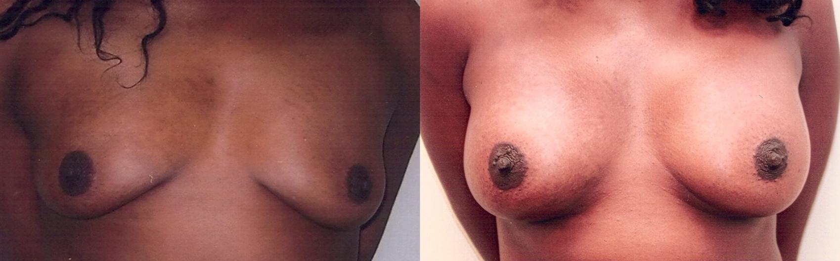 Before & After Breast Augmentation Case 24 View #1 View in Mississauga & Toronto, ON