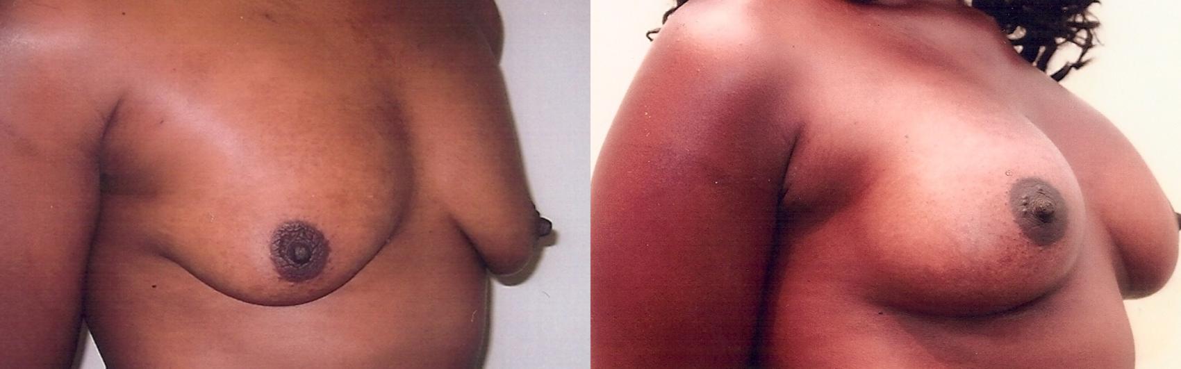 Before & After Breast Augmentation Case 24 View #2 View in Mississauga & Toronto, ON