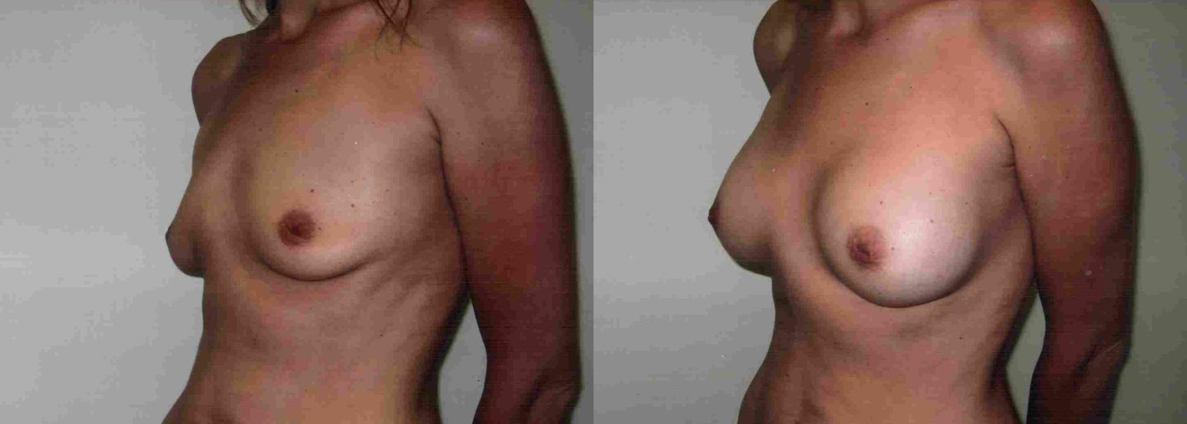 Before & After Breast Augmentation Case 28 View #1 View in Mississauga & Toronto, ON