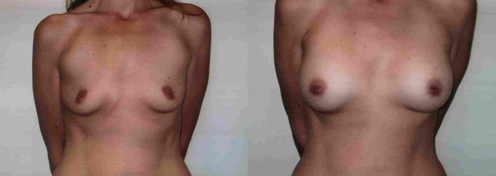 Before & After Breast Augmentation Case 28 View #2 View in Mississauga & Toronto, ON