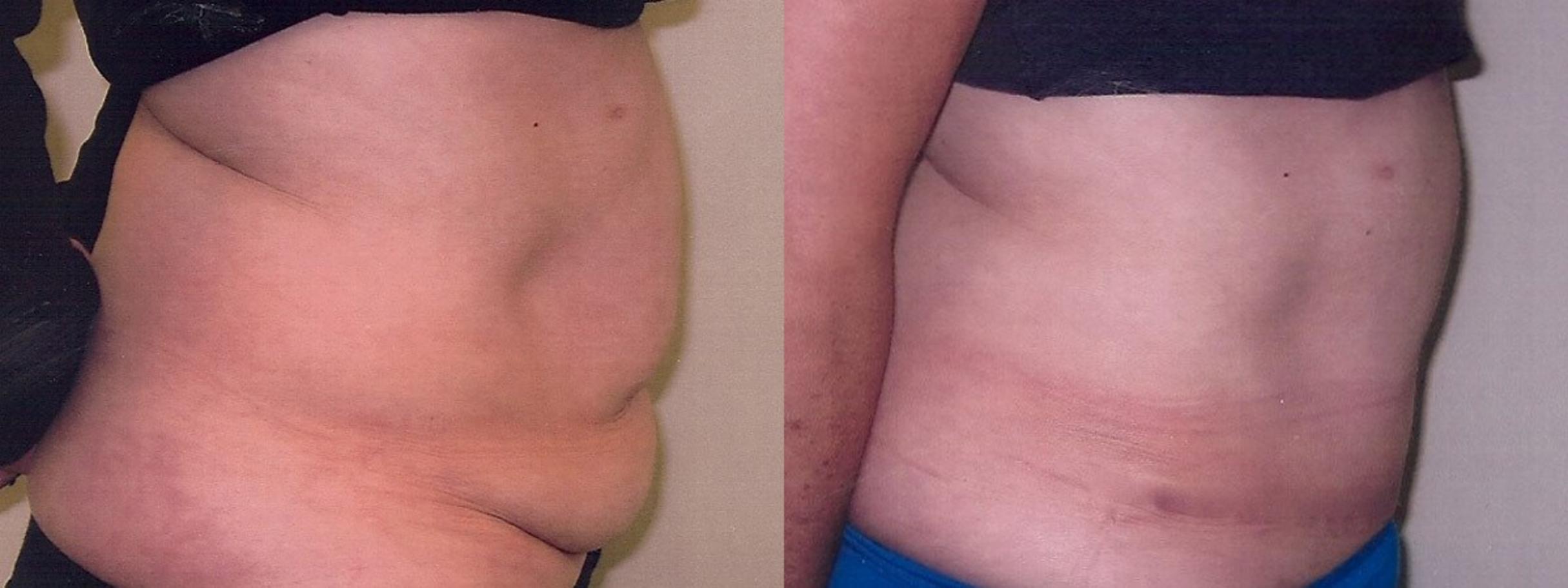 Before & After Tummy Tuck Case 3 View #2 View in Mississauga & Toronto, ON