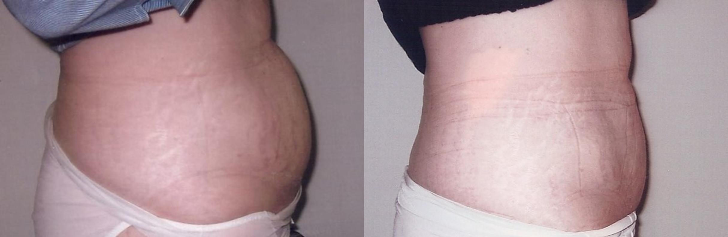 Before & After Liposuction Case 30 View #1 View in Mississauga & Toronto, ON