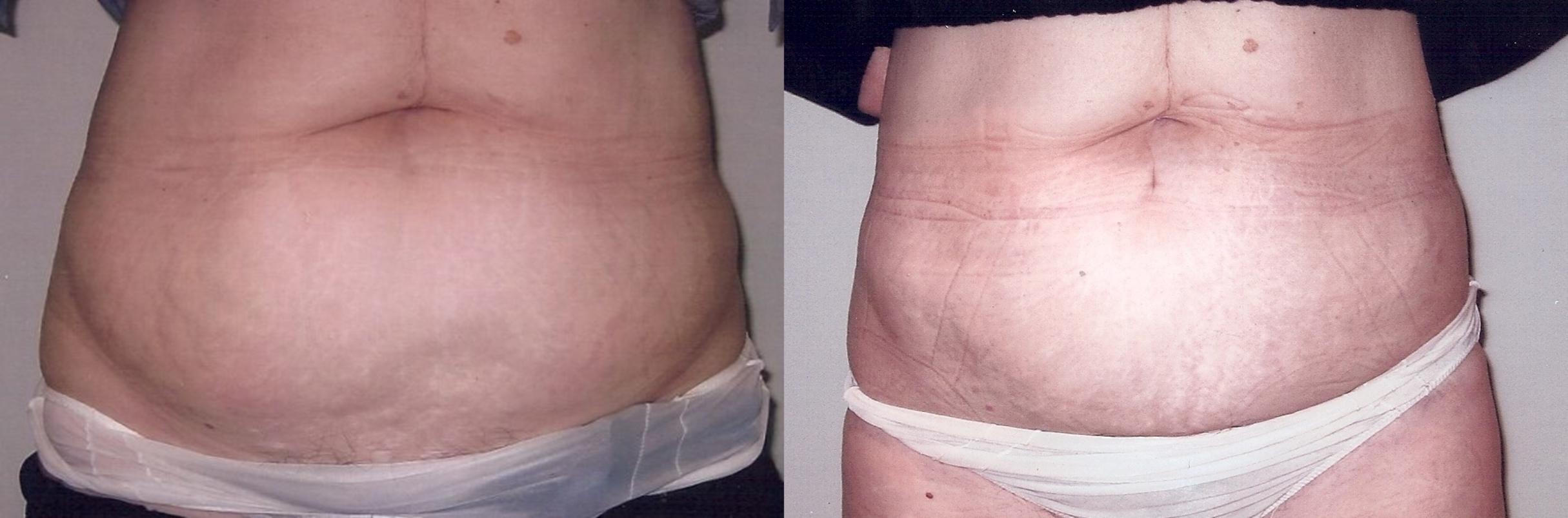 Before & After Liposuction Case 30 View #2 View in Mississauga & Toronto, ON