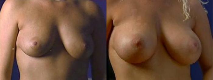 Before & After Breast Augmentation Case 32 View #2 View in Mississauga & Toronto, ON